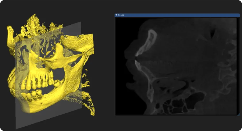 Yellow skull mesh beside a slice window showing its voxel cross-section