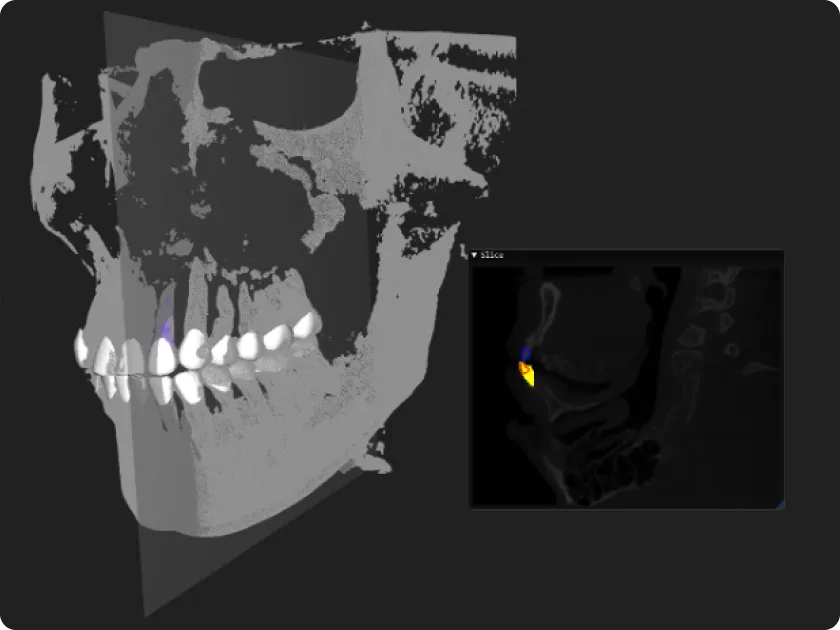 Skull voxels with one tooth selected in color and a slice window