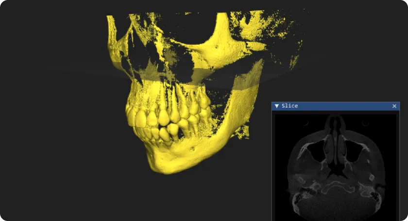 Skull voxel volume reconstructed from radiographs with an axial slice
