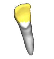 Tooth chip aligned onto the main mesh after ICP, surfaces in two colors